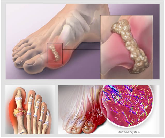 (DÀNH CHO GOUT XƯƠNG KHỚP) CAO GẮM DÂN TỘC TÀY - LIỆU TRÌNH 3 THÁNG